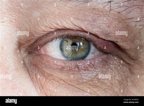 Inflamed Male Eye With Chalazion On Eyelid From Close Up Stock Photo