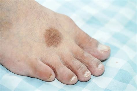 Identifying and Treating Rare Foot Conditions