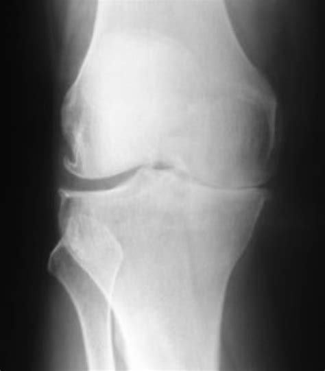 Knee X Ray Understanding The Signs Of Arthritis Hubpages