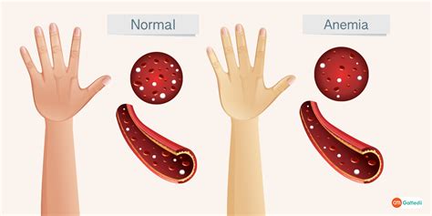 Anemia Rash Symptoms