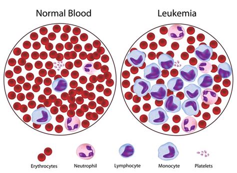 Acute Myeloid Leukemia Mbbch Health Encyclopedia