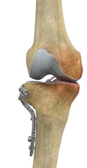 High Tibial Osteotomy Surgery Everett Knee Arthritis Treatment