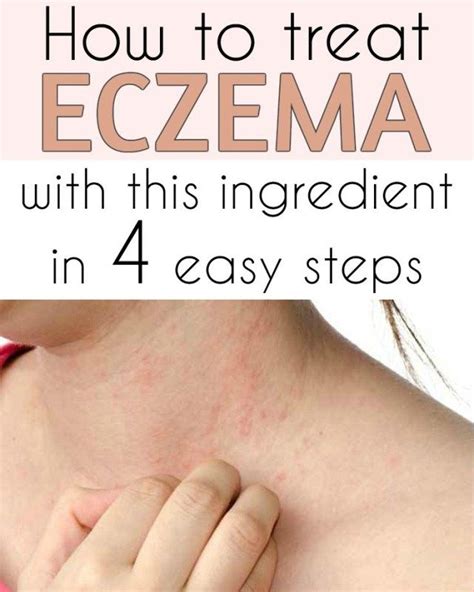 How To Treat Eczema And This Ingredient In 4 Easy Steps All What You