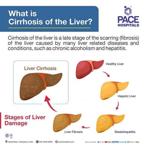 Liver Cirrhosis Symptoms Causes Complications And Prevention
