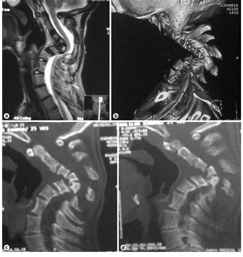 A Mri Of Cervical Spine Sagittal T2w Image Showing Severe Cervical