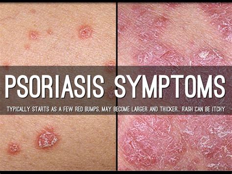 Psoriasis By Melissa Jurado