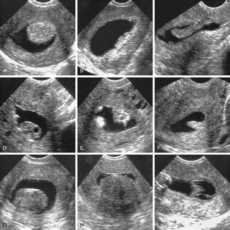 Benign Gynecologic Lesions Vulva Vagina Cervix Uterus Oviduct Ovary Ultrasound Imaging Of