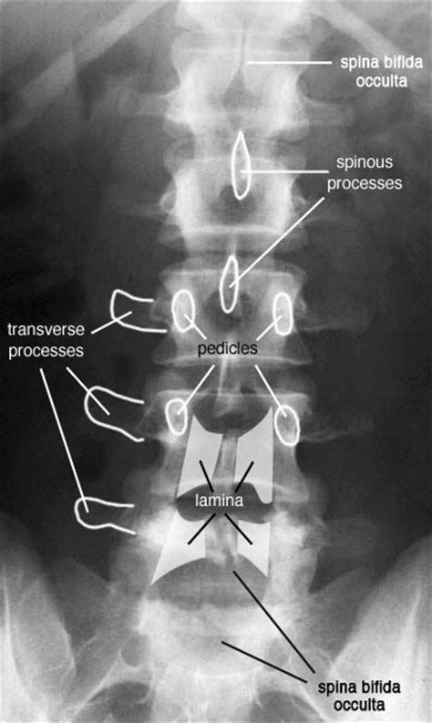 Radiographic Anatomy Of The Skeleton Lumbar Spine Ap View Labelled
