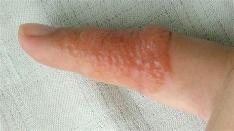 Dyshidrotic Eczema Pictures