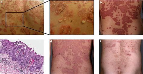 A Disseminated Sharply Demarcated Erythematous Plaques And
