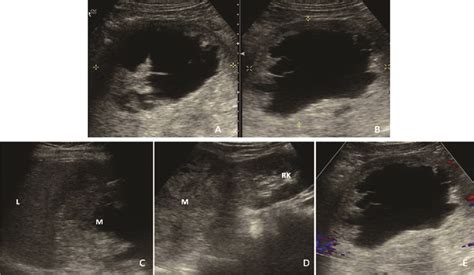 A And B Transverse And Sagittal Sonographic Images Revealing A Complex