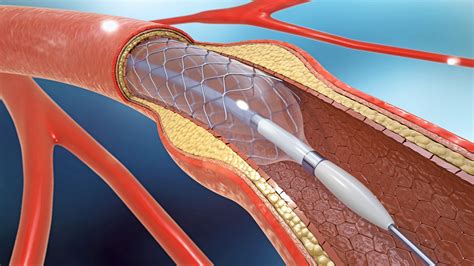 Coronary Balloon Angioplasty And Stenting In Colorado Denver Ahvc