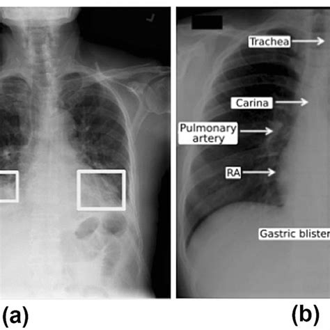 A Example Of Pulmonary Opacities B Normal Chest Radiography Showing
