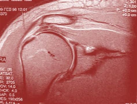 But it will heal and leave you with improper shoulder biomechanics, which could lead to bone spurs and pain and less stability. Will A Rotator Cuff Tear Heal Without Surgery?