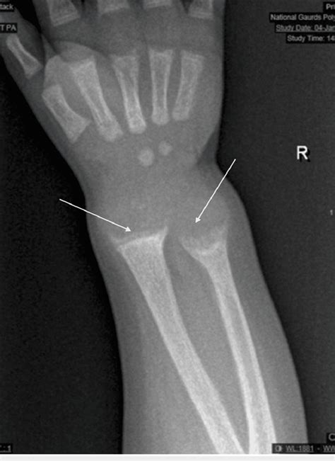 X Ray Of The Wrist Showing Fraying Widening And Cupping Of The