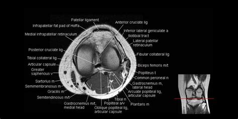 Label The Structures Of The Knee The Knee Mri Atlas O Vrogue Co