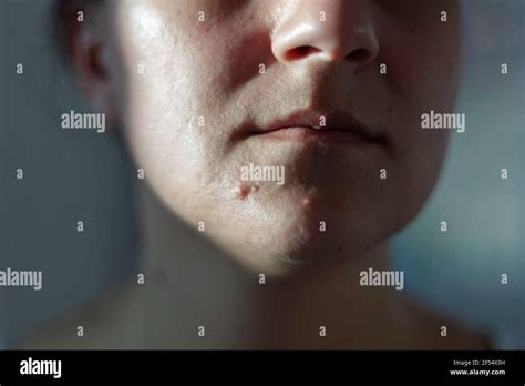 Girl With Problematic Acne On The Face Closeup Stock Photo Alamy
