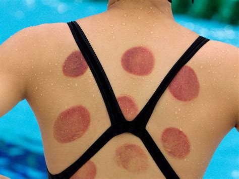 Olympian Michael Phelps Has Circle Marks From Cupping Therapy Benefits Cupping Therapy