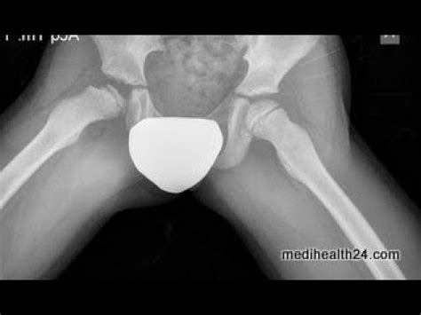 A study of 610 children under 12 years of age at disease onset. Legg calve perthes disease X-ray Describe | diagnosis ...