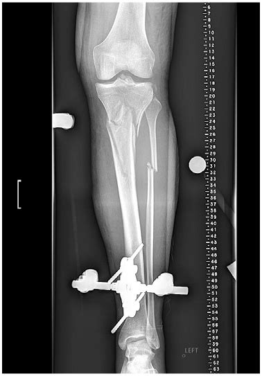 Managing High Energy Proximal Tibia And Fibula Fracture Hss Case