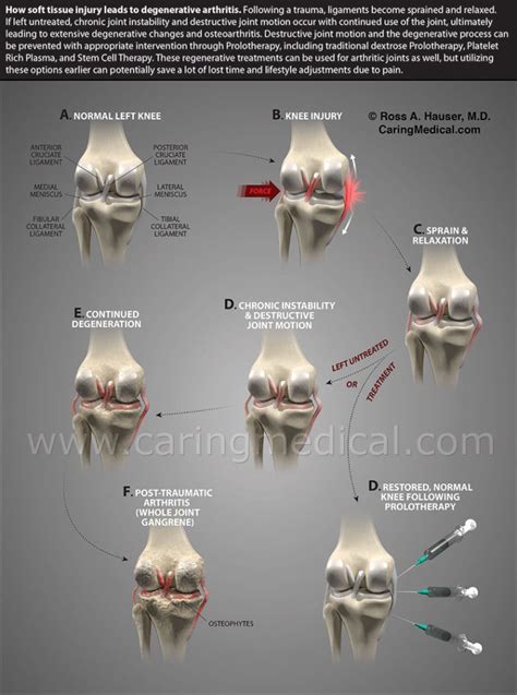Medial Collateral Ligament Knee Injury Caring Medical
