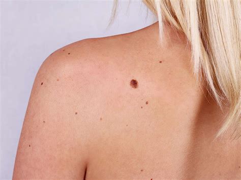 Skin Cancer 10 Symptoms Of Skin Cancer