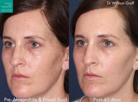 Laser Skin Treatments San Diego Ca Cosmetic Laser Dermatology