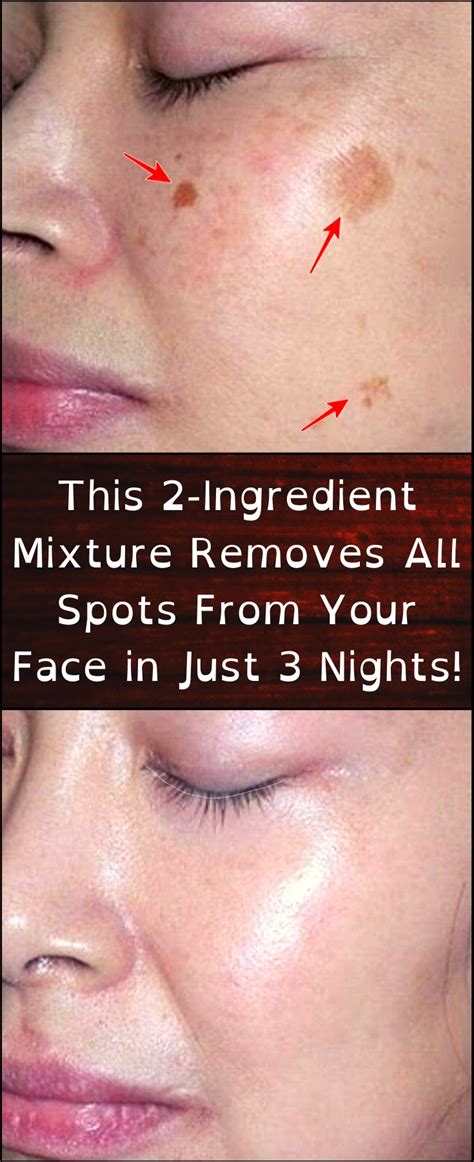 It Will Take 5 Minutes Of Your Time Spots On Face Brown Spots On