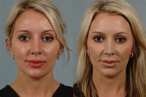 Juvederm Under Eye Filler Before And After All You Need Infos