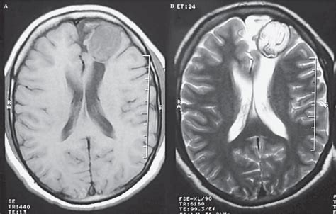 A Axial T1 Weighted Mri Of The Brain Showing A Well Defined Slightly