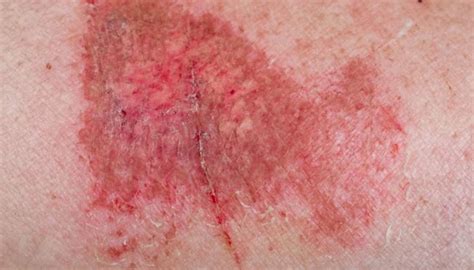 How To Get Rid Of Rug Burn Scars Rugs Ideas
