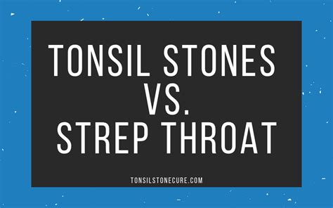 Tonsil Stones Or Strep Throat How To Tell The Difference Tonsilstonecure