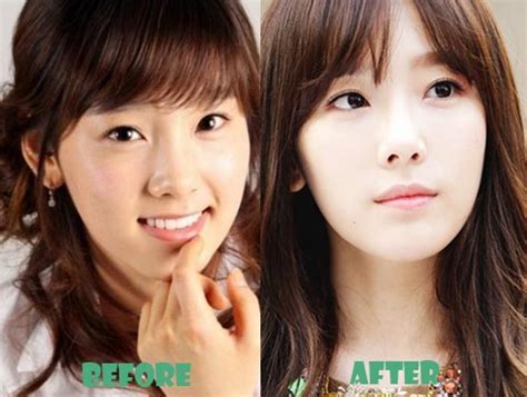 Taeyeon Snsd Celebrities Before And After Plastic Surgery Celebrity