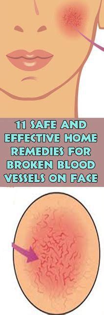 11 Safe And Effective Home Remedies For Broken Blood Vessels On Face