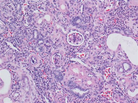 Pathology Outlines Nephroblastomatosis Nephrogenic Rests