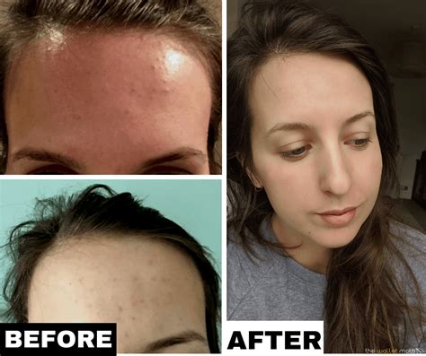 How I Cleared My Tiny Bumps On Forehead Once And For All 2022