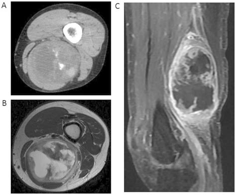 Cystic Extraskeletal Osteosarcoma Three Case Reports And Review Of The