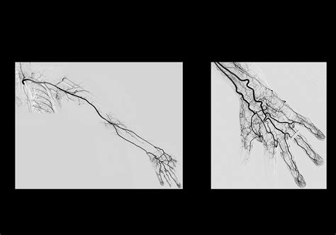 Arterial Vascular Anatomy Of The Upper Limb Dsa E Anatomy