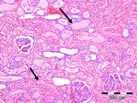 Renal Tubular Necrosis Note Protein Casts Top Arrow Within Necrotic