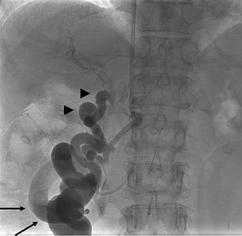 A Retrograde Right Ovarian Venography Showed Duodenal Varices Arrow