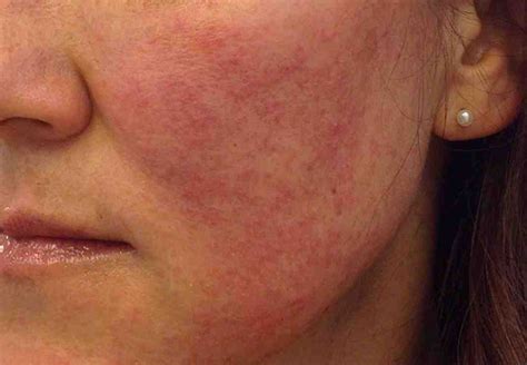 Omaha Dermatology Skin Face Rash Treatment Skin Specialists Pc