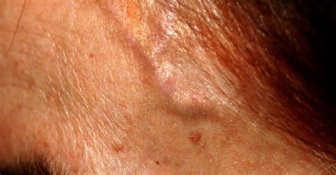 Forehead Veins Causes Of Bulging And Treatment