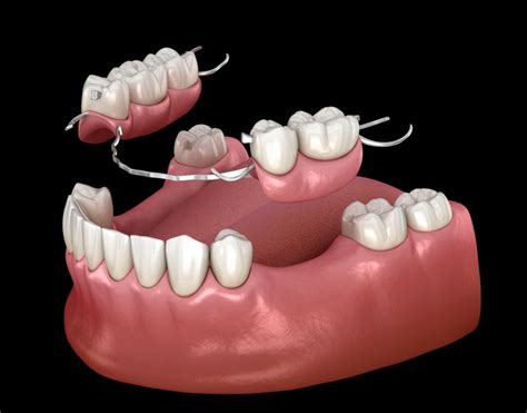 Difference Between Partial Dentures And Dental Bridges Missing Teeth