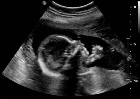 20 Weeks Pregnant Ultrasound Pictures