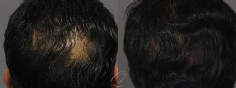 Male Crown Hair Restoration Before After Photos Patient