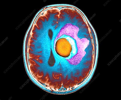 Brain Cancer Mri Stock Image C0472040 Science Photo Library