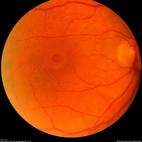 Macular Hole Annan Retina Eye Center In Houston Texas