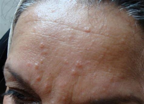 Sebaceous Hyperplasia Treatment Photos Removal Causes