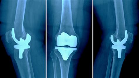 Wandl Is Accepting Depuy Knee Failure Cases