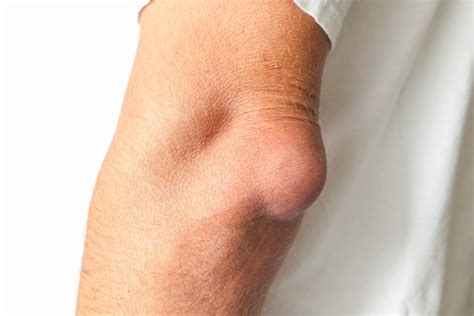 What Is Olecranon Bursitis And How To Manage Elbow Pain Upswing Health